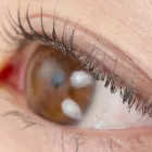 フラットラッシュ